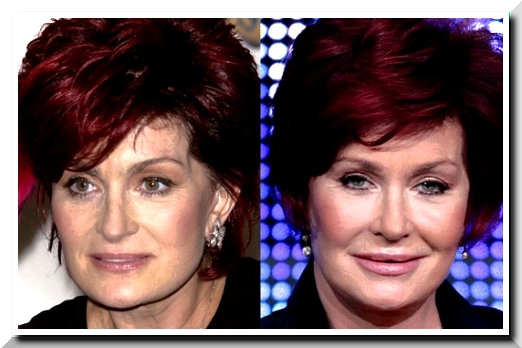Sharon Osbourne,  It’s Embarrassing to Have Many Times Plastic Surgery
